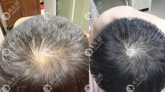 非那雄胺片用了8个月真实效果