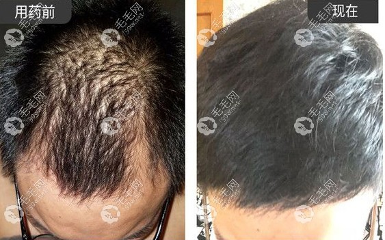 非那雄胺片吃了4年的真实案例