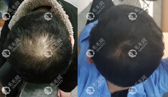 非那雄胺一年效果明显