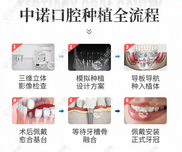 海淀中諾口腔醫(yī)院種植牙過程和步驟