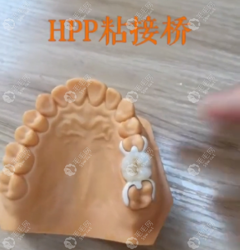 HPP粘接桥能用多久