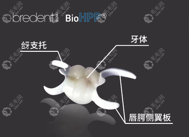 HPP粘接桥到底是什么