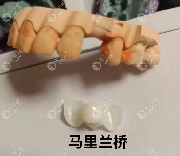 HPP粘接橋是馬里蘭橋嗎？揭秘兩者5大區(qū)別，選錯(cuò)后悔10年！