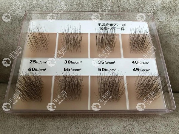 植发1000/2000/3000/4000个毛囊有多大面积