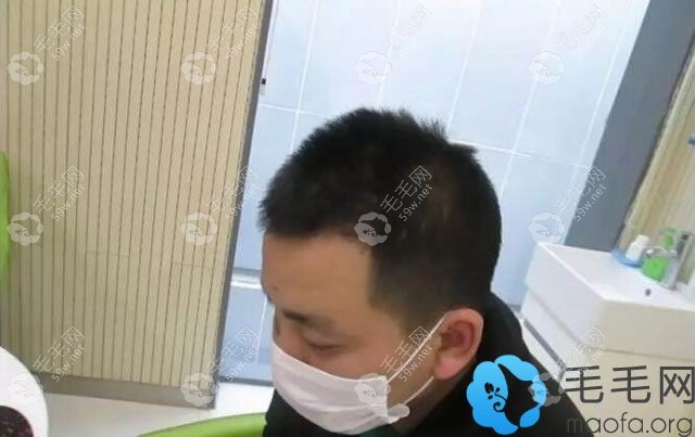 北京中德為發(fā)友植發(fā)半年的效果圖