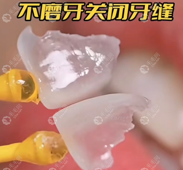 2025武汉超薄牙齿贴面医院排名top10