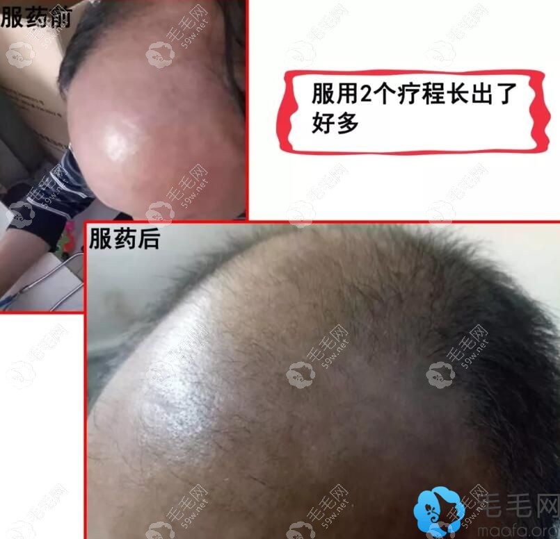 顾客服用2个疗程生发丸据说头发也长出来好多