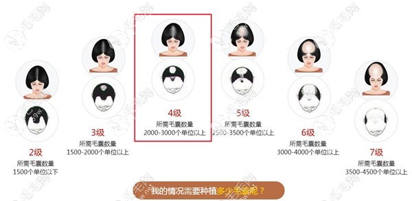 O型秃顶预算2万差不多可以搞定