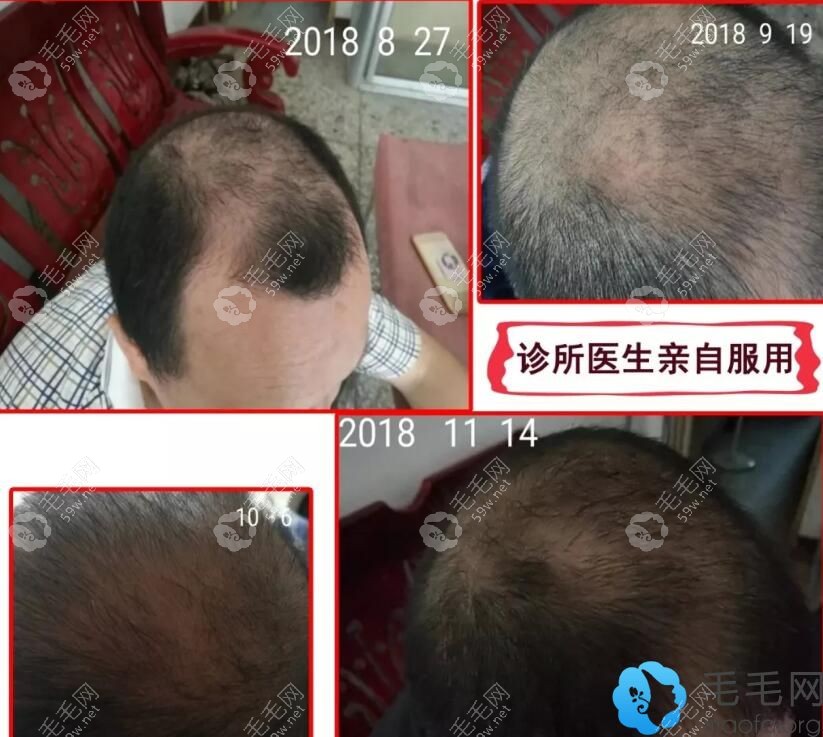 顾客自曝吃了九芝堂生发丸的效果