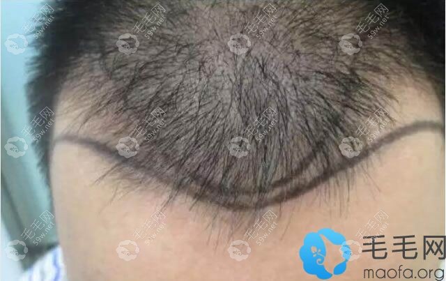 北京中德植發(fā)設(shè)計(jì)的手術(shù)方案