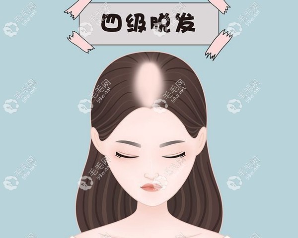 四級(jí)脫發(fā)也不算是晚期