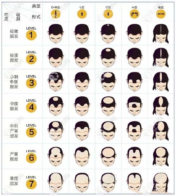 脫發(fā)1-7級(jí)程度圖