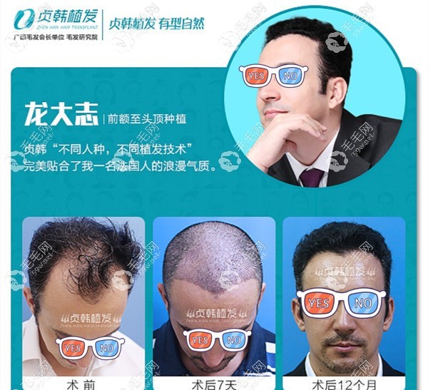南宁贞韩男士发际线种植恢复图片