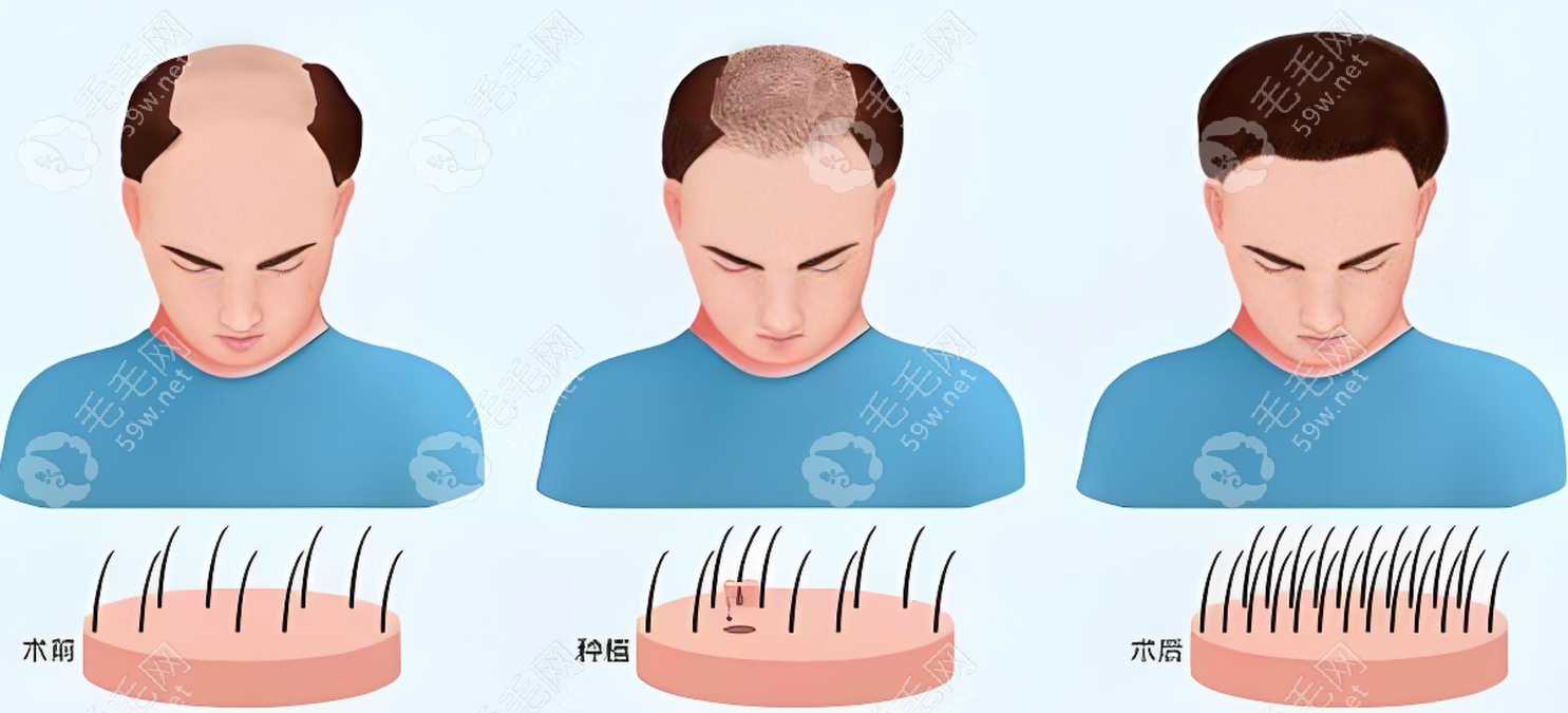 西安科大毛发医院毛发种植可靠