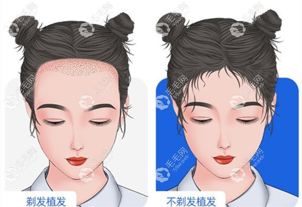 不剃发技术可以做发际线调整