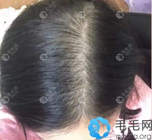 我使用米诺地尔半年了