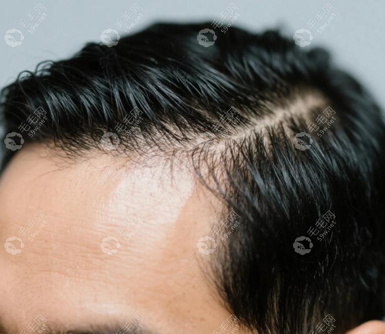 去南方医院植发要提前多久预约