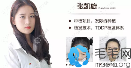 女性发际线种植案例（从用TDDP植发体系）