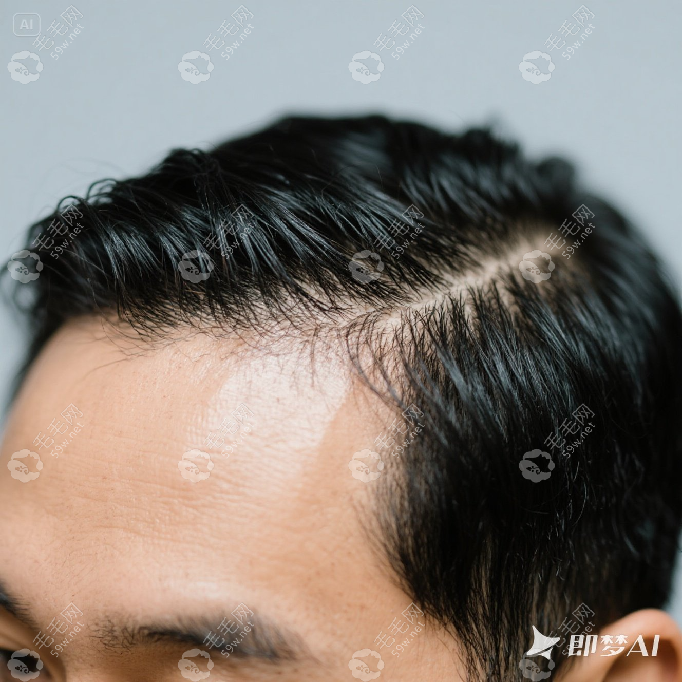 广州南方医院植发可以不剃发