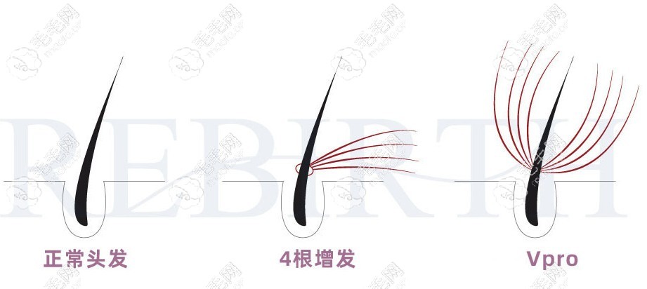增发是在每根头发底部绑一小缕头发来使头发变多的