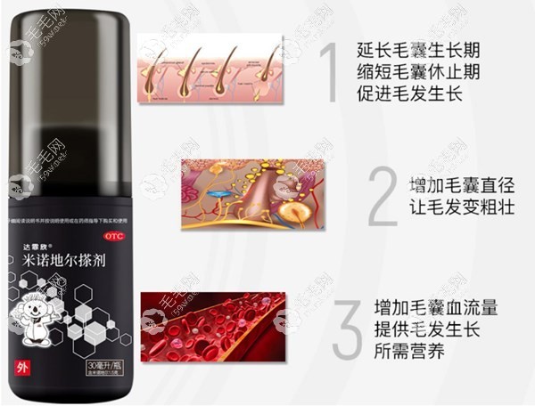 米诺地尔外用药物