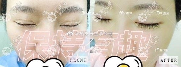 李会民植发医生睫毛种植效果图