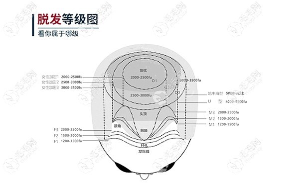 男女脫發(fā)程度參考圖片