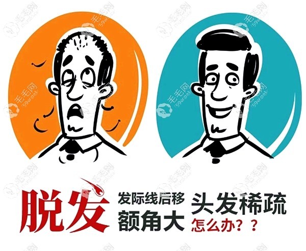 發(fā)際線后移+額角大可以植發(fā)改變