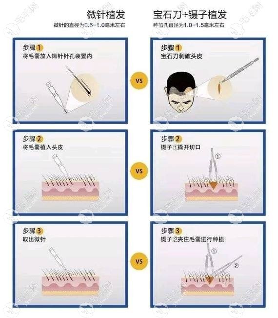 fue无痕植发技术和微针植发技术区别