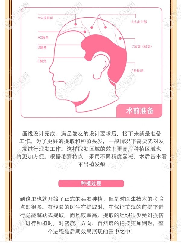 怎么前移發(fā)際線的過(guò)程