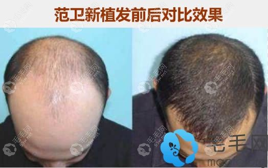 范衛(wèi)新治療脫發(fā)的案例效果