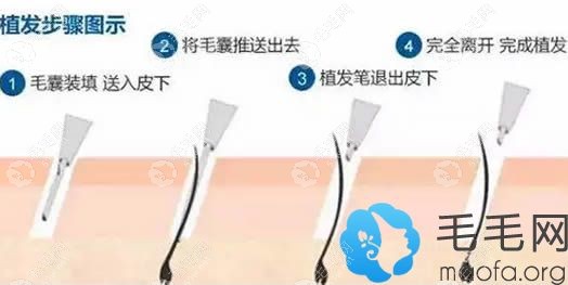 植發(fā)手術(shù)過程圖示