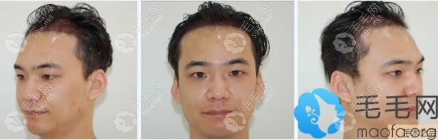 做完手术当天的照片