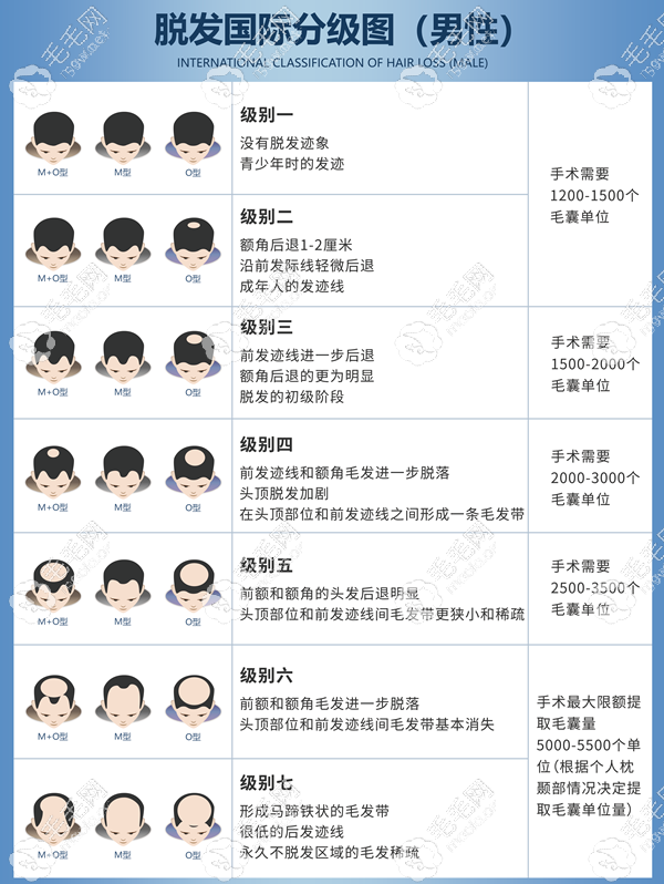 枣庄M型发际线植发的价格
