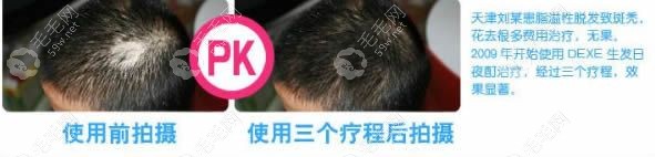 使用過生發(fā)酊顧客的對(duì)比效果