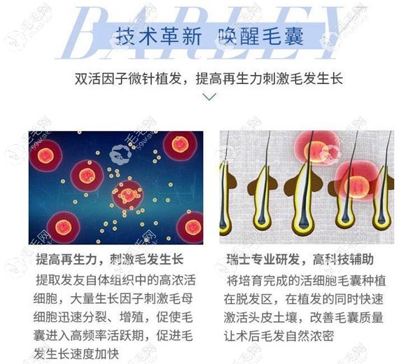 大麥雙活因子微針植發(fā)