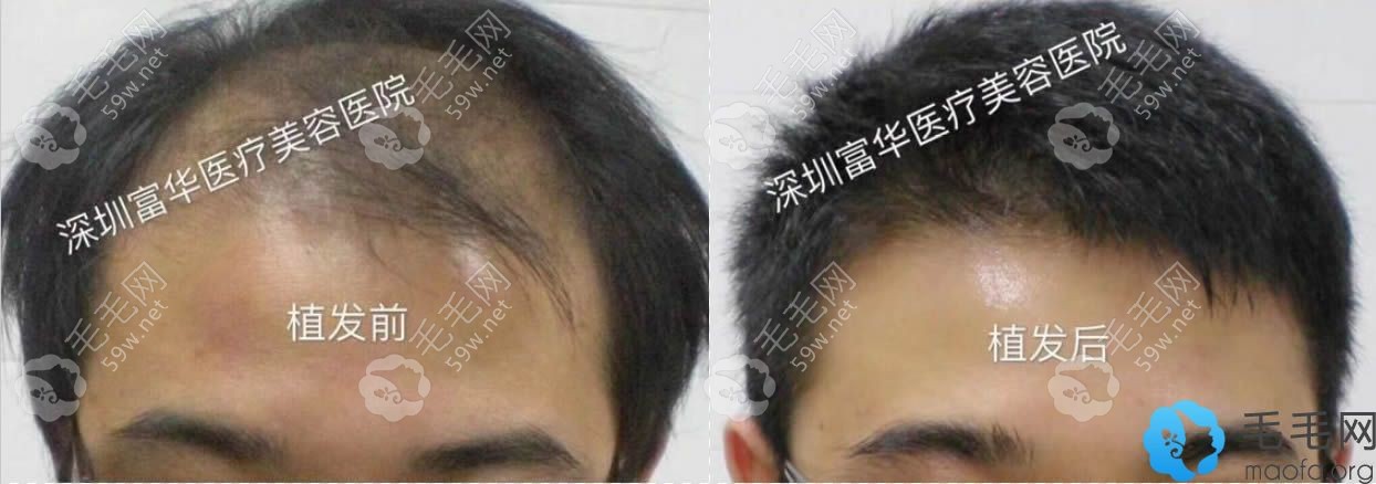 深圳富华男士秃顶植发前后对比效果