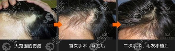 疤痕植发效果前后对比