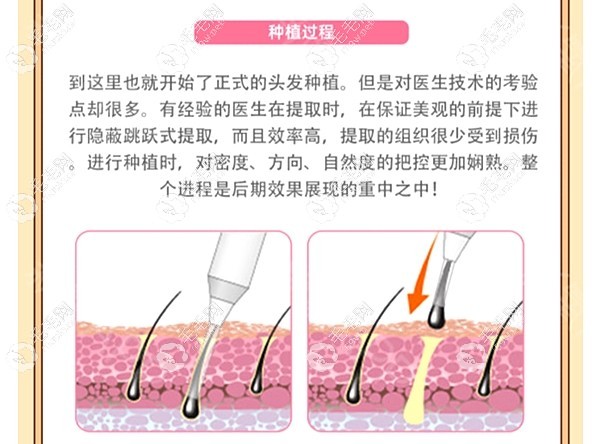 碧莲盛BHT2.0植发的特点