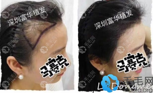 女生发际线过高植发2025单位后对比照