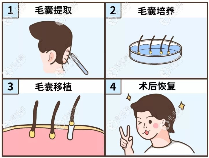植发手术的详细步骤
