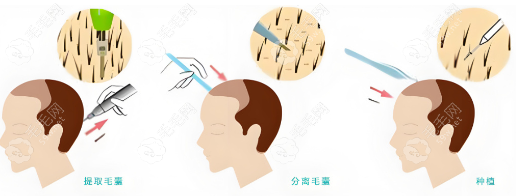 大麥植發(fā)預(yù)約掛號(hào)