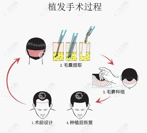 植發(fā)手術的過程圖