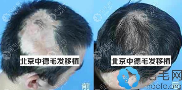 北京中德疤痕植发案例效果