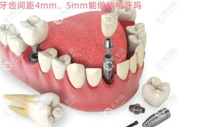 牙齿间距4mm或5mm可以做种植牙吗