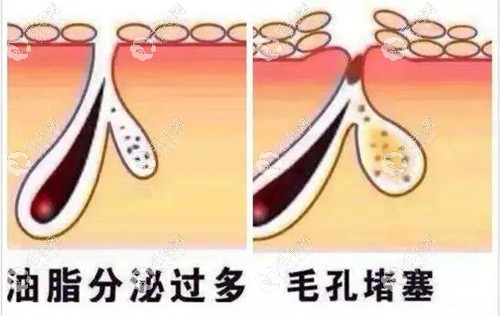 脂溢性脱发的产生原因