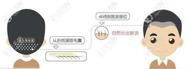 脂溢性脱发可以植发改善