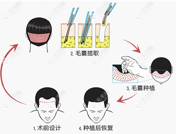 国内植发技术成熟吗