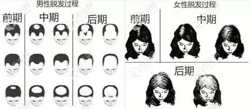 脂溢性头发的不同时间表现
