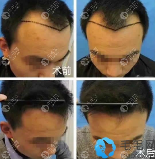 昆明丽都植发际线效果前后对比